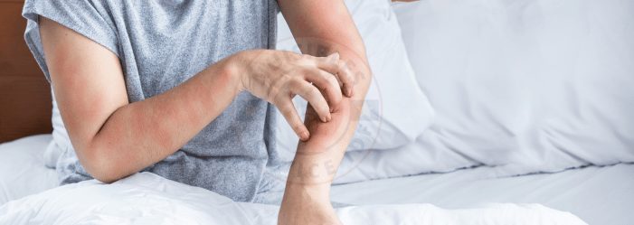 piqûre de punaises de lit